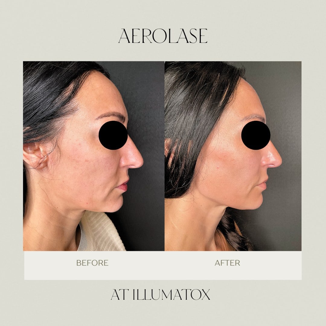 A before and after of Aerolase treatment showing reduced facial redness at Illumatox in Neenah