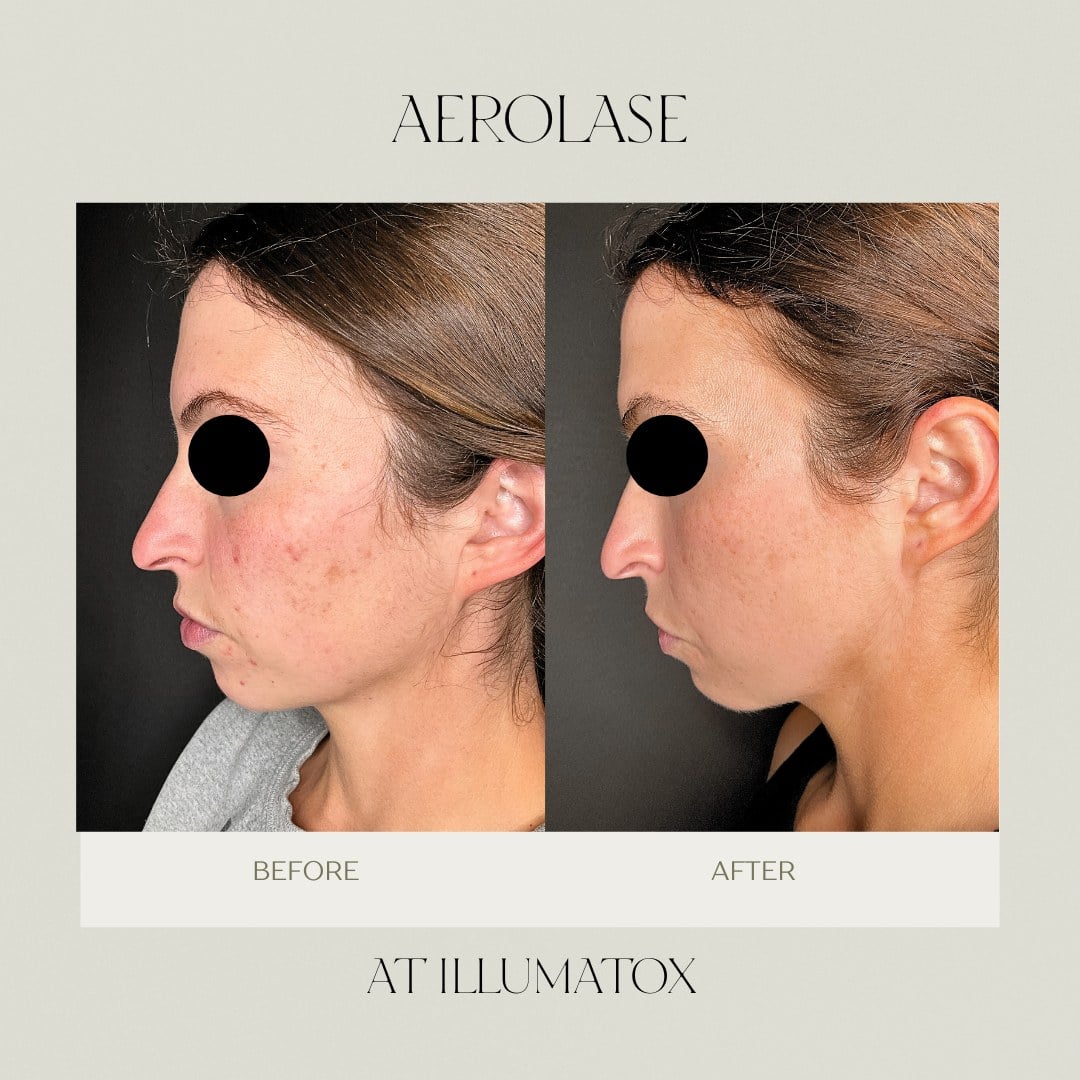 A before and after after two Aerolase treatments showing calmer, less congested skin at Illumatox