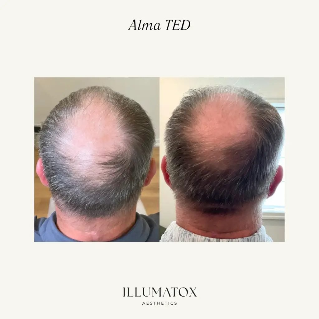 Before and after Alma TED hair restoration on a man's crown at Illumatox in Neenah