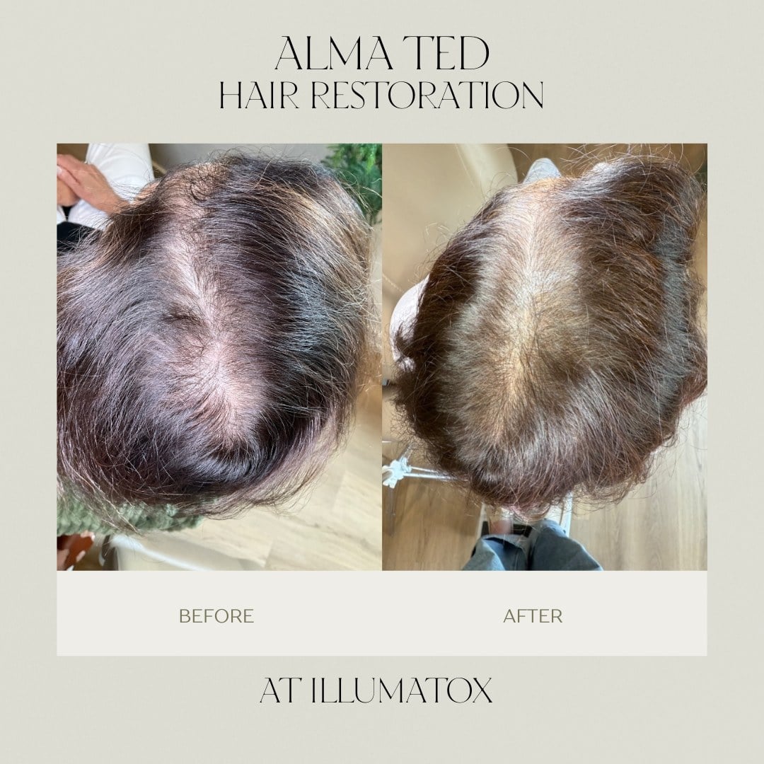 A before and after of Alma TED hair restoration showing increased density at the part line