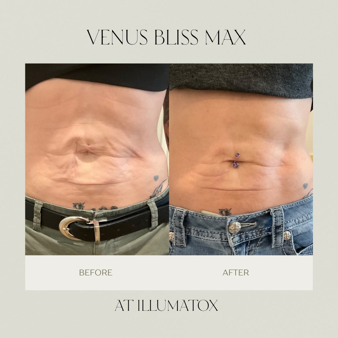 A before and after of abdominal radiofrequency skin tightening at Illumatox in Neenah