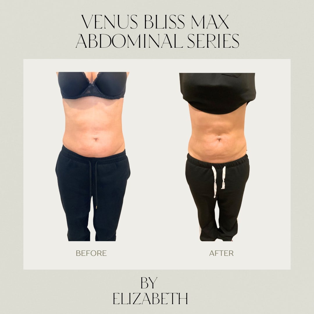 A before and after of a Venus Bliss MAX abdominal contouring series at Illumatox in Neenah