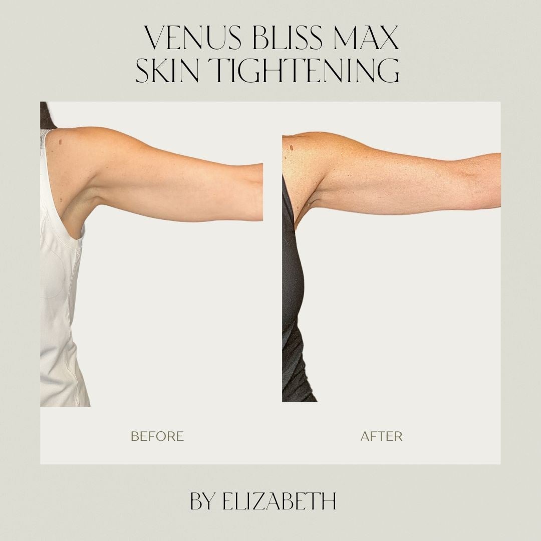 A before and after of radiofrequency skin tightening on the upper arm at Illumatox in Neenah