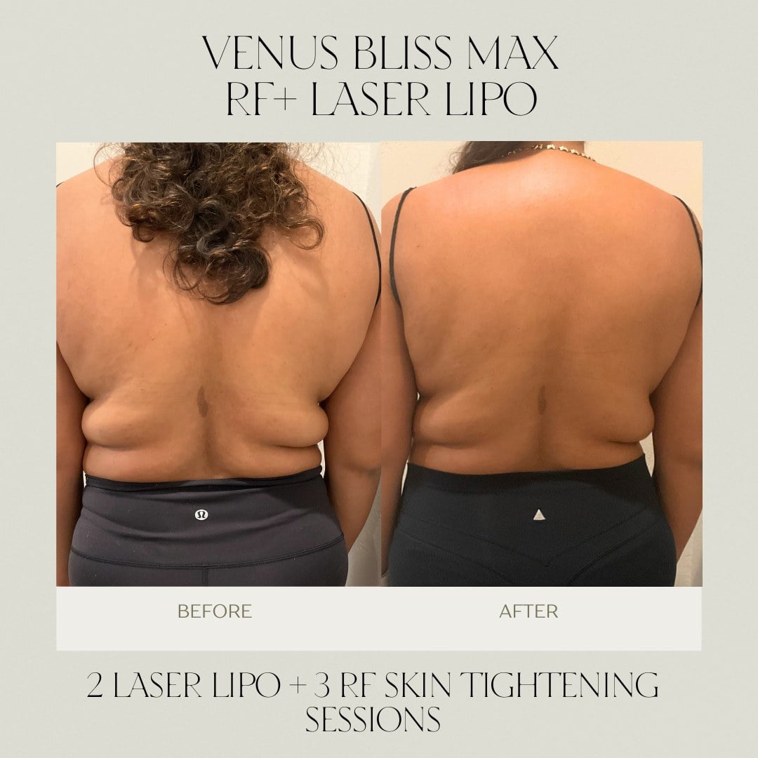 A before and after of laser lipo and RF skin tightening across the back at Illumatox in Neenah