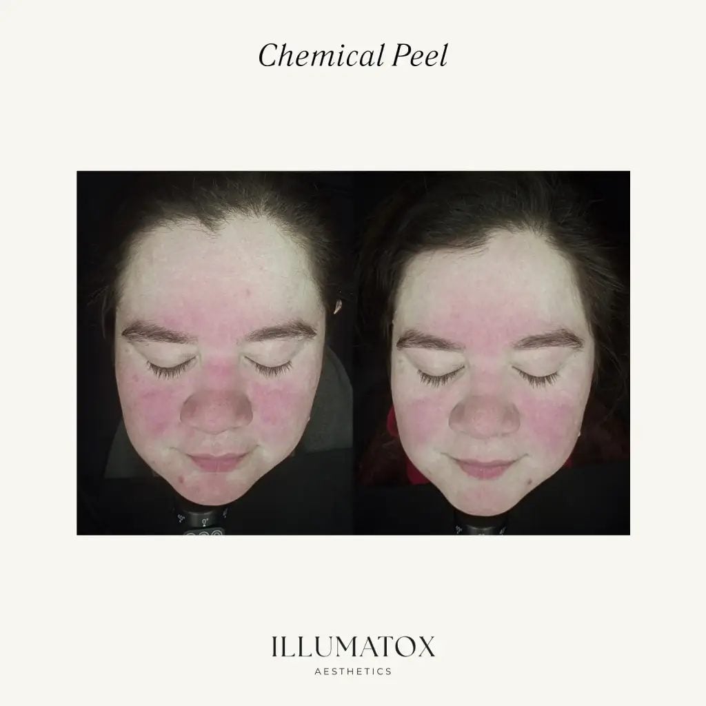 Before and after a chemical peel showing calmer, more even skin at Illumatox in Neenah