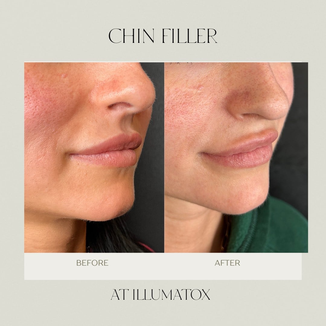 A before and after of chin filler adding projection to the lower face at Illumatox in Neenah