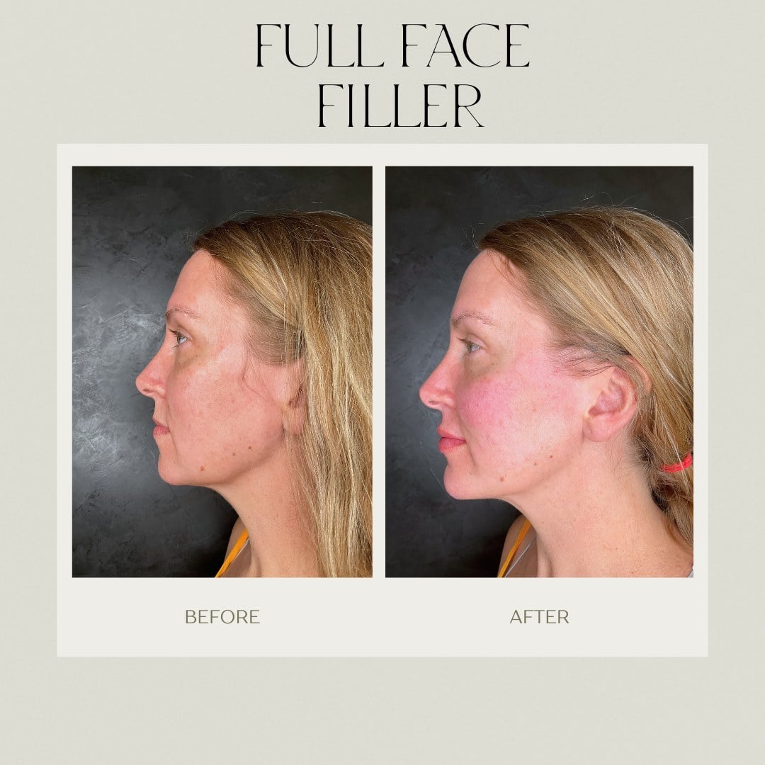 A before and after profile showing restored cheek and jawline structure at Illumatox in Neenah