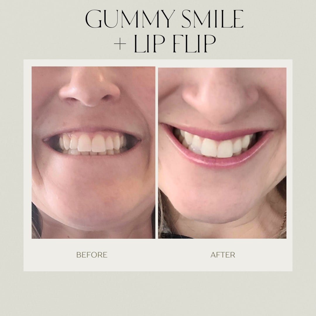 A before and after of a combined gummy smile and lip flip treatment at Illumatox in Neenah