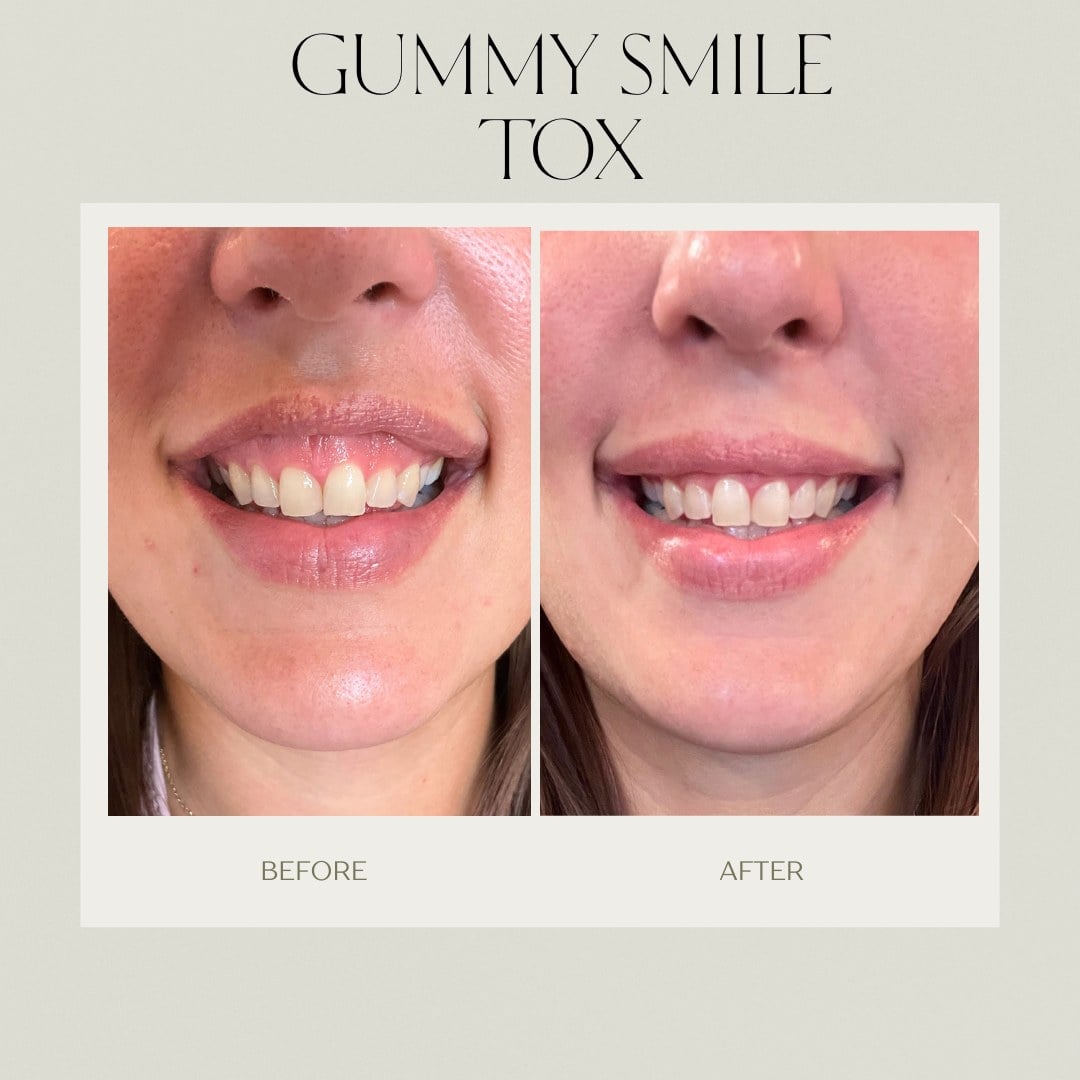 A before and after showing less upper gum visible when smiling, treated at Illumatox in Neenah
