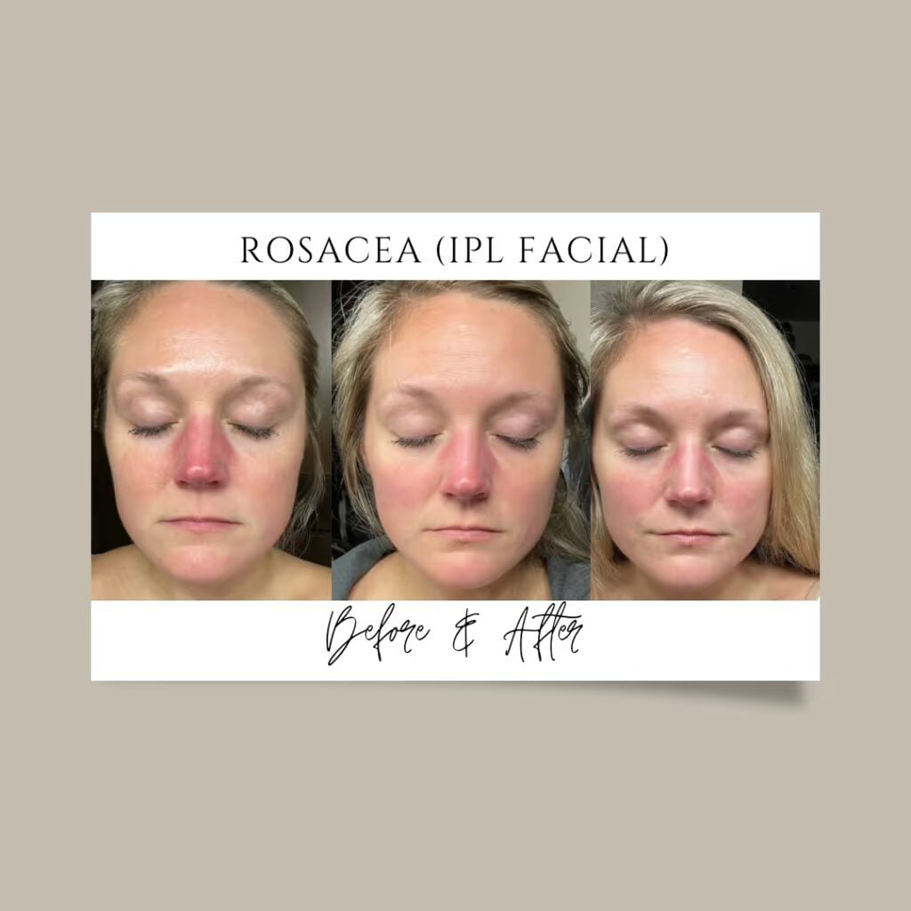 Rosacea redness before and after IPL photofacial treatment at Illumatox in Neenah