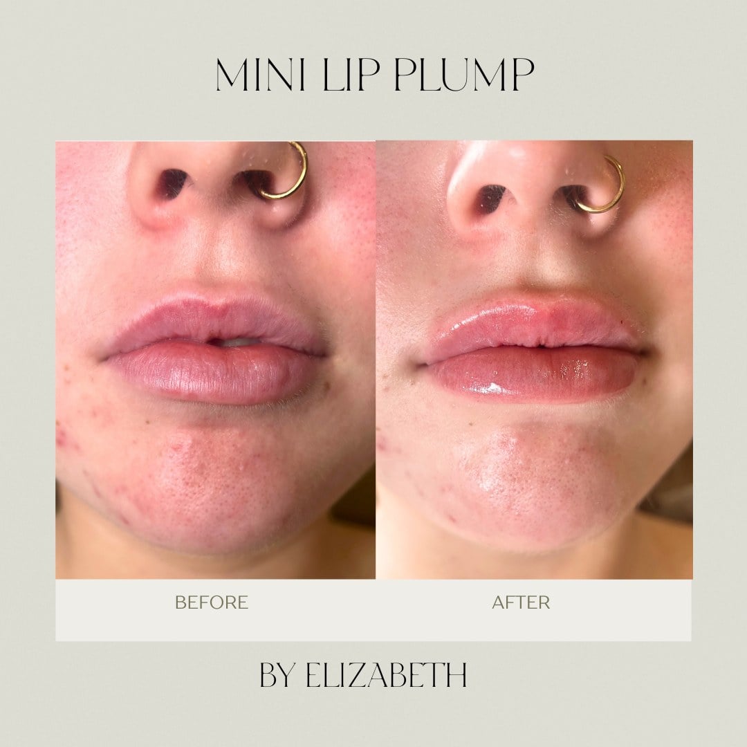 A before and after of lip filler showing subtle shape definition, treated by Elizabeth at Illumatox