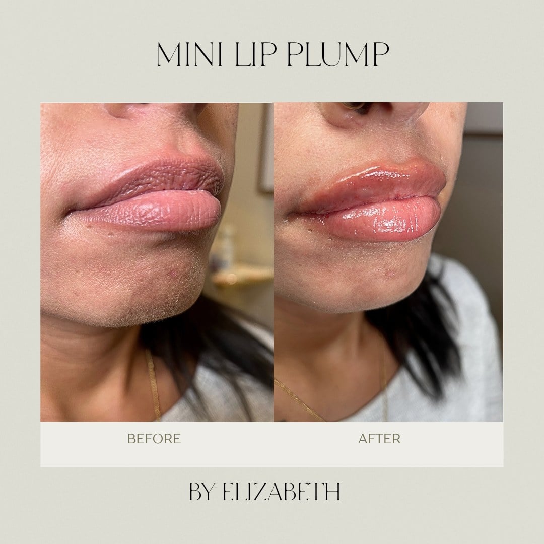 A before and after of lip filler showing a subtle increase in volume at Illumatox in Neenah