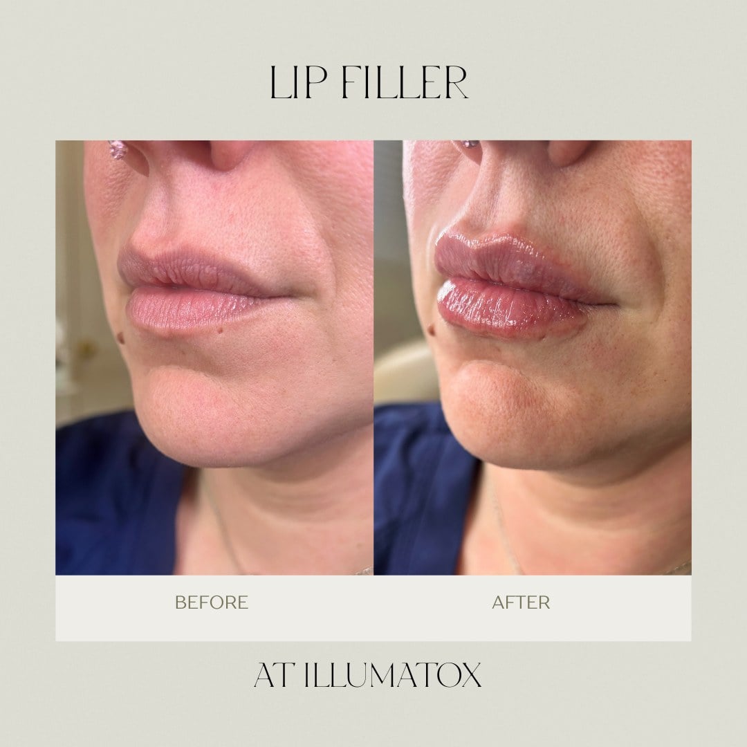Before and after lip filler treatment at Illumatox Aesthetic Studio in Neenah