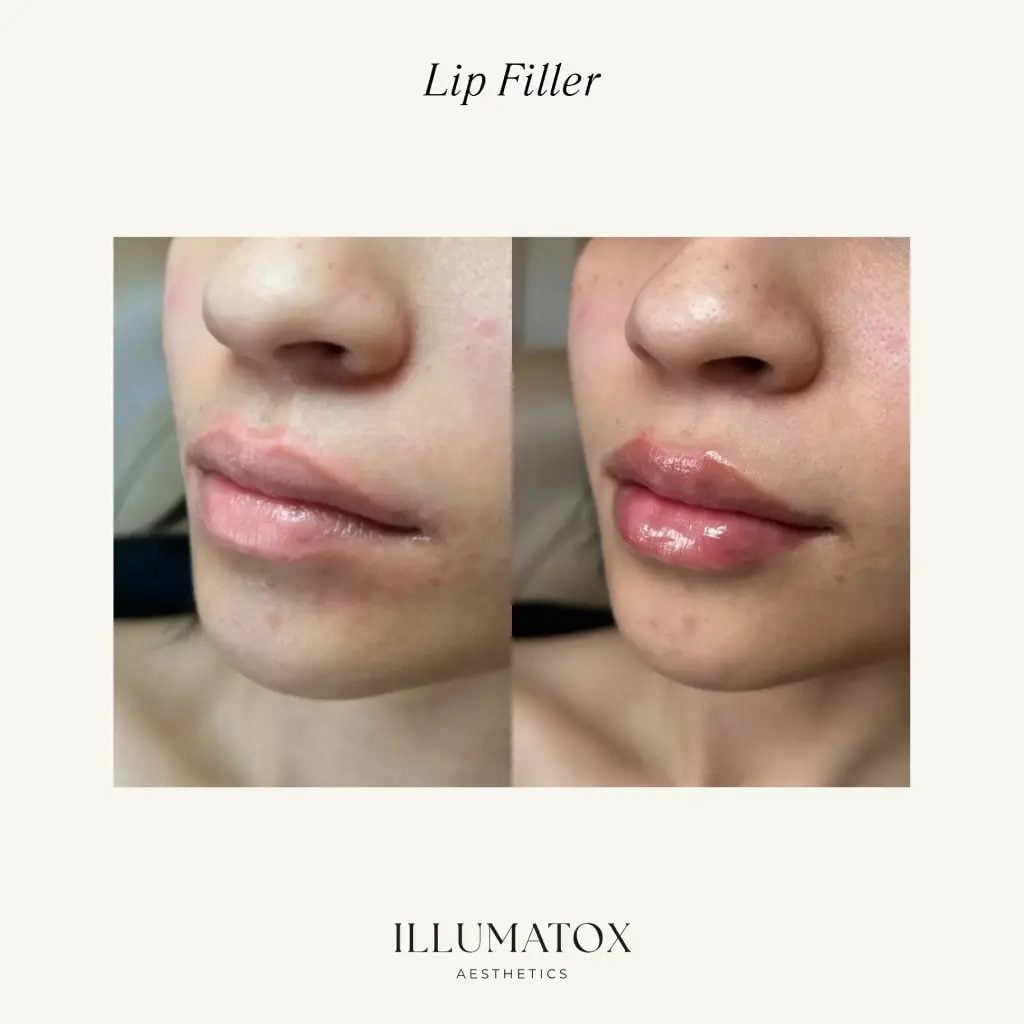 Before and after lip filler shown at an angle at Illumatox in Neenah