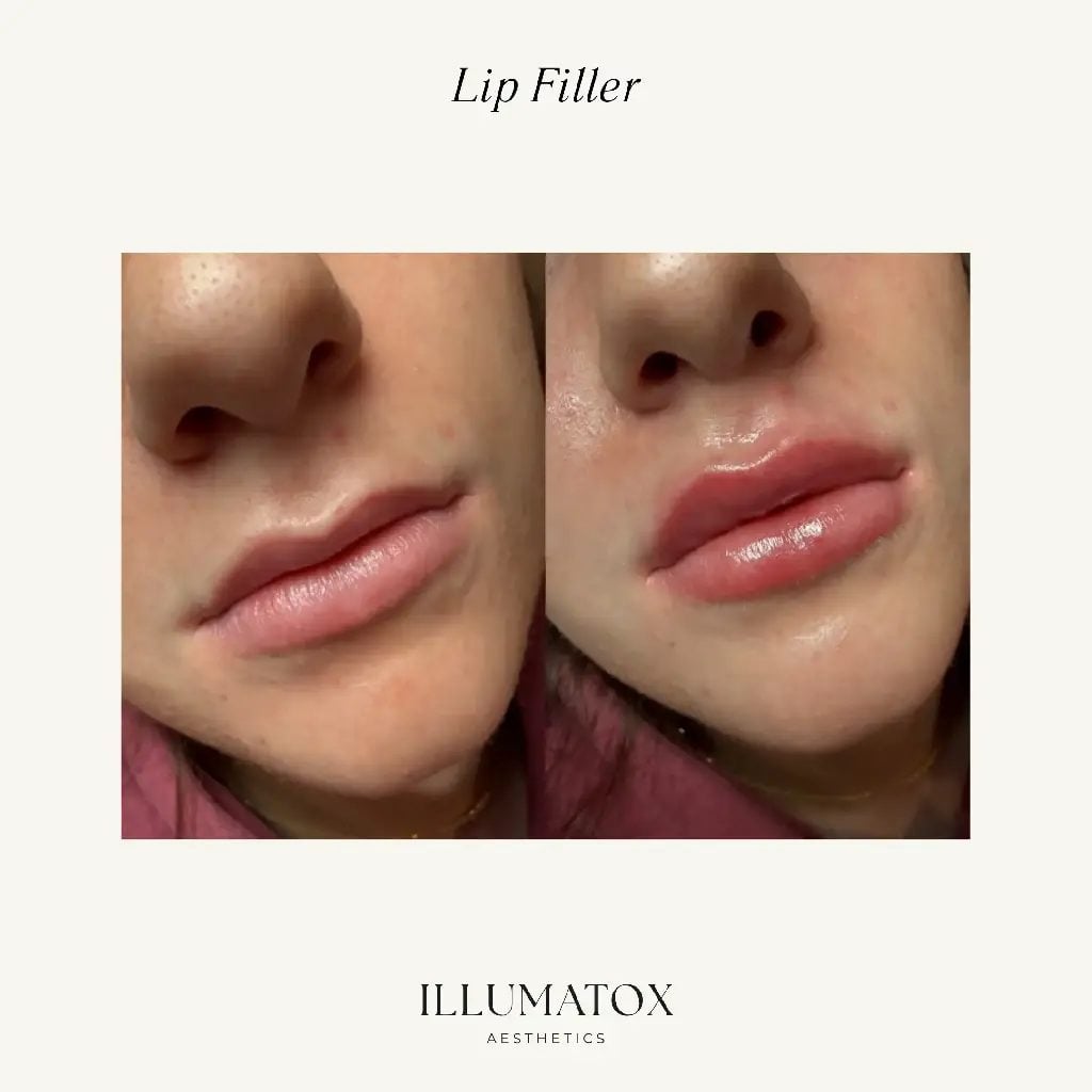 Before and after lip filler with a defined upper lip at Illumatox in Neenah