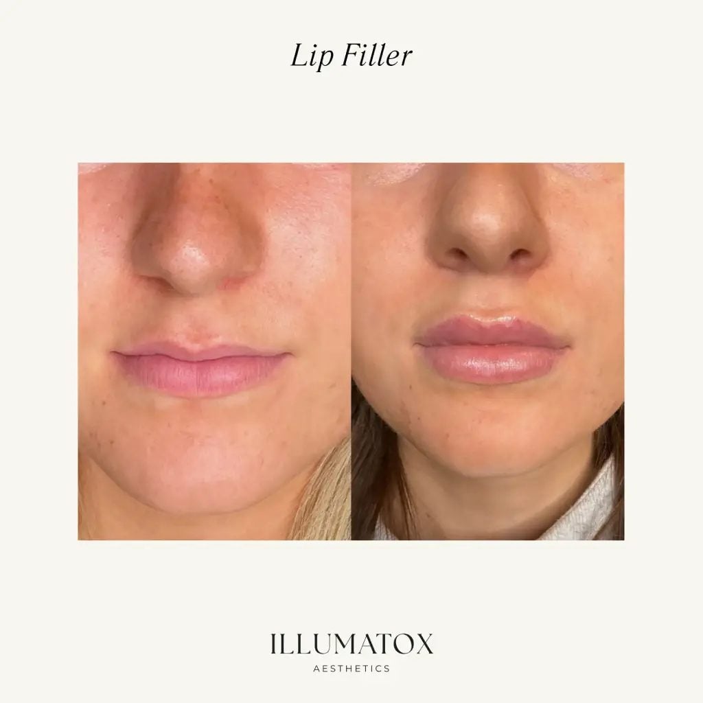 Before and after lip filler adding shape and volume at Illumatox in Neenah