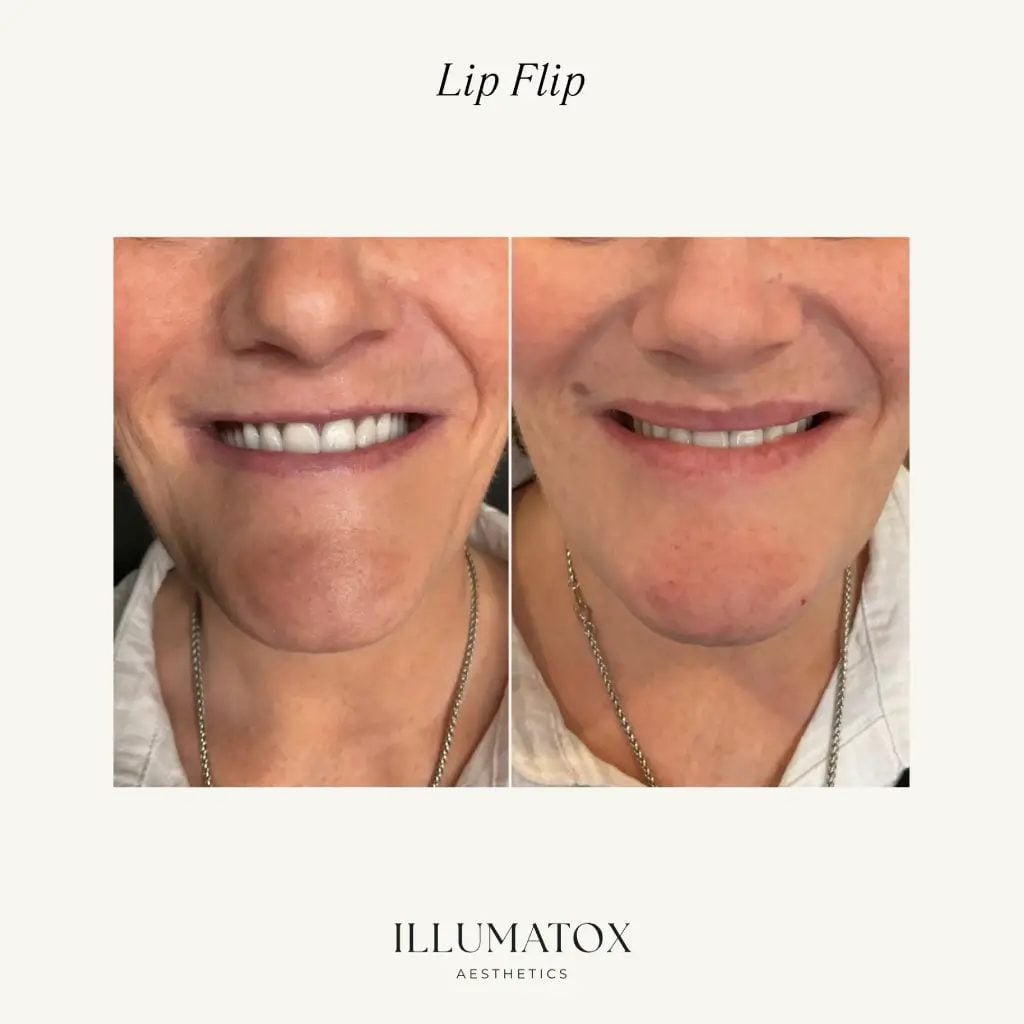 Before and after a lip flip showing more upper lip in a smile at Illumatox in Neenah