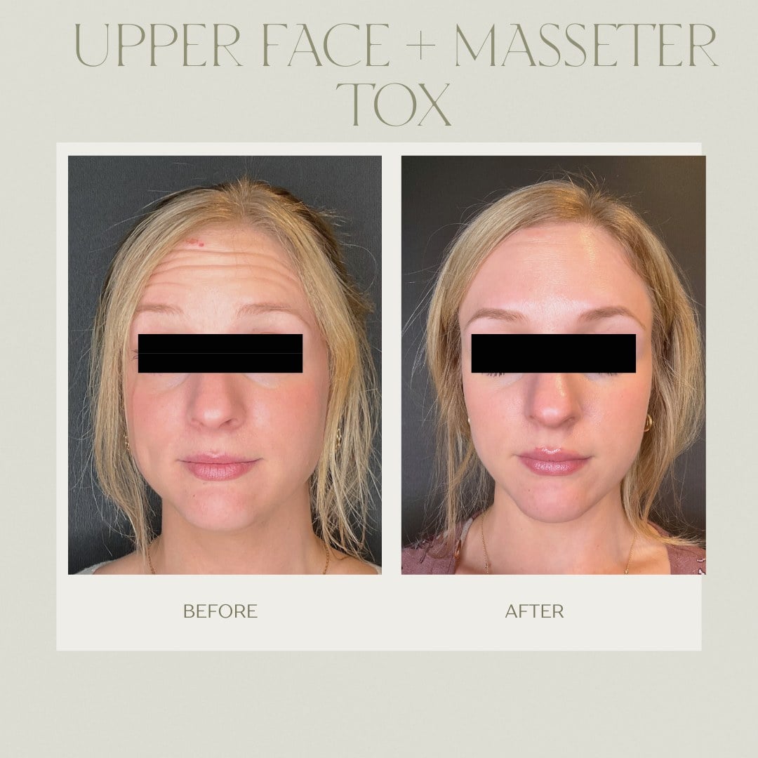 A before and after of upper face and masseter wrinkle relaxer treatment at Illumatox in Neenah