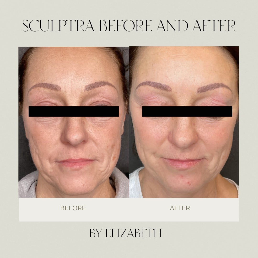 Before and after Sculptra collagen stimulation across the mid-face at Illumatox in Neenah