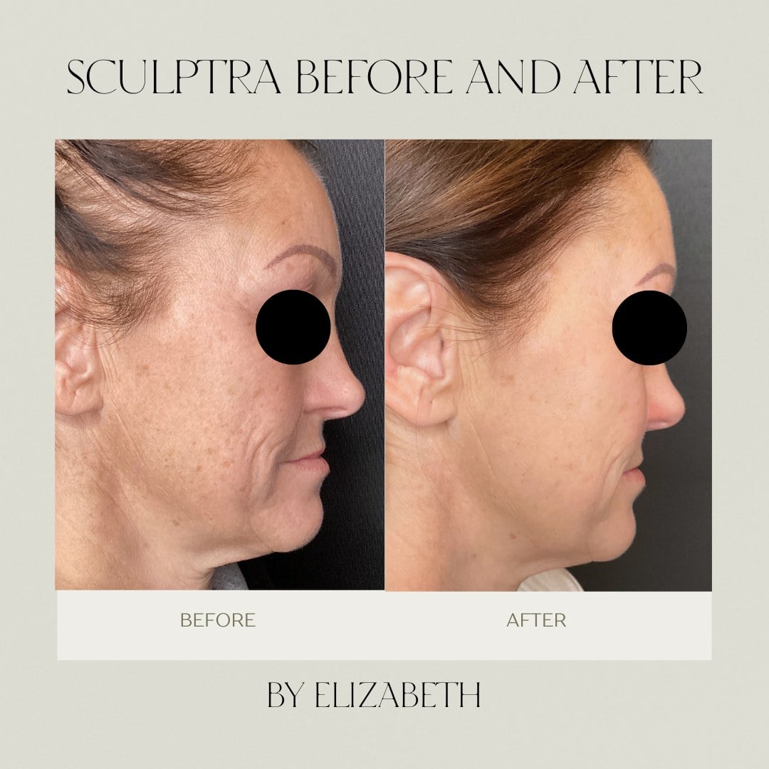 Before and after Sculptra treatment shown in profile at Illumatox in Neenah