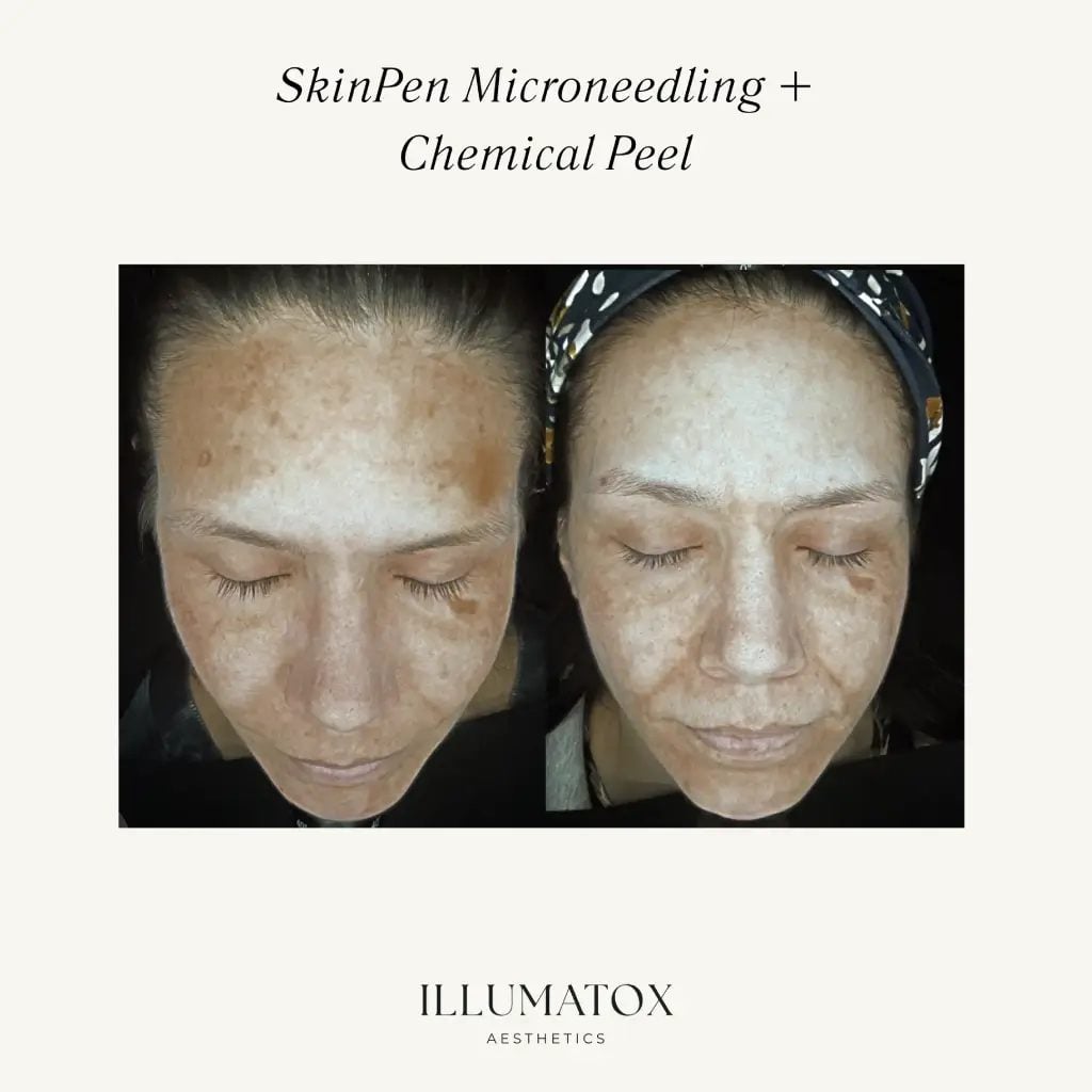 Before and after SkinPen microneedling combined with a chemical peel for sun damage at Illumatox in Neenah