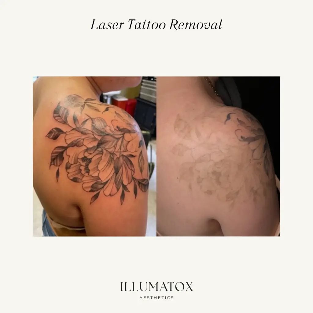 A shoulder tattoo before and after laser tattoo removal sessions at Illumatox in Neenah