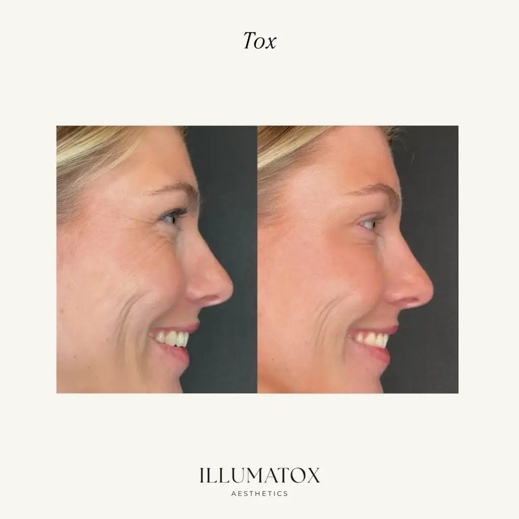 Before and after crow's feet softened with tox, shown in profile, at Illumatox in Neenah