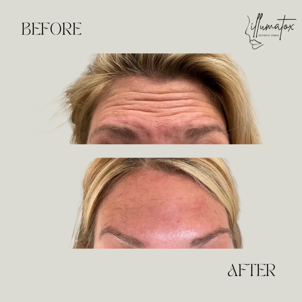 Before and after forehead lines softened with wrinkle relaxers at Illumatox in Neenah