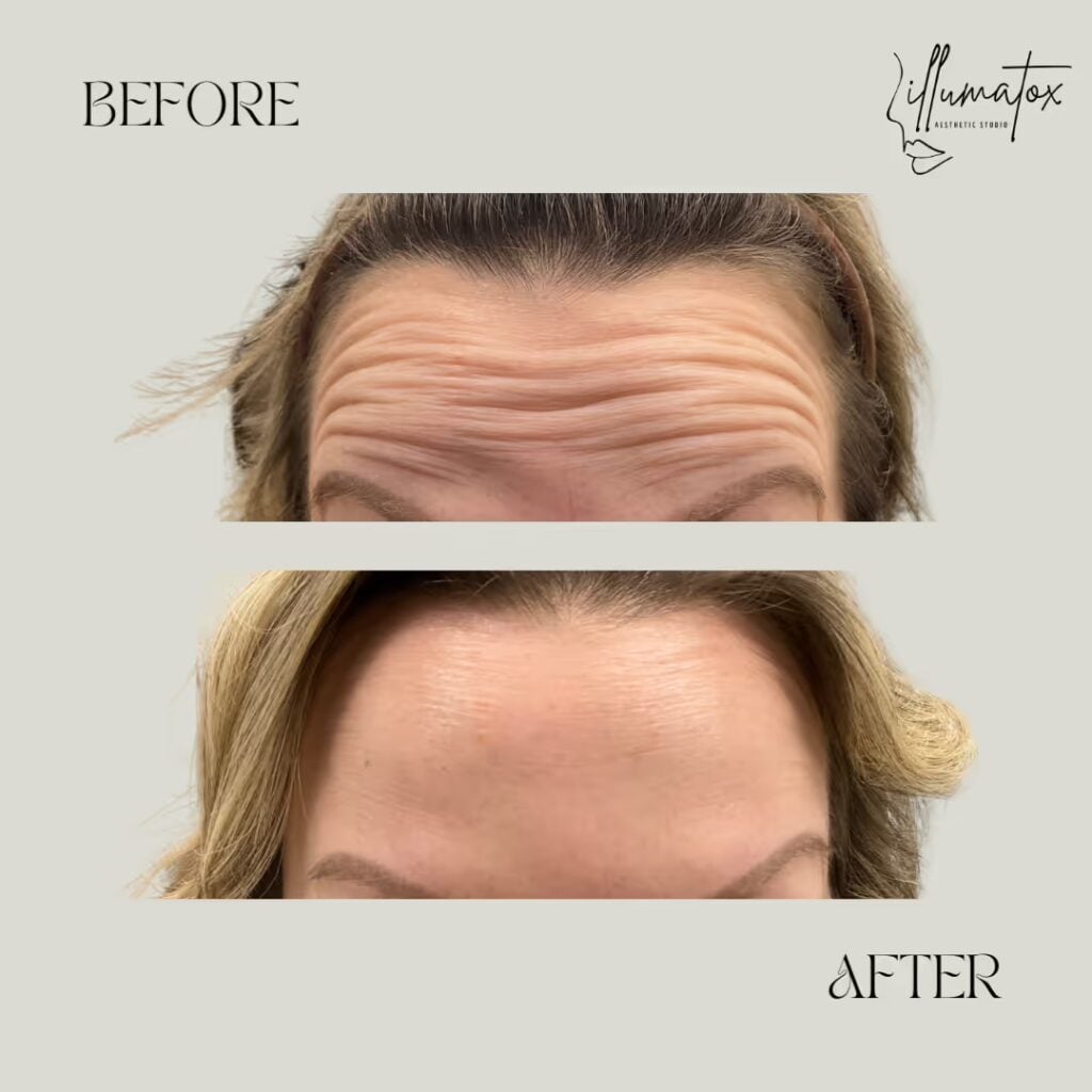 Before and after deep forehead lines treated with wrinkle relaxers at Illumatox in Neenah