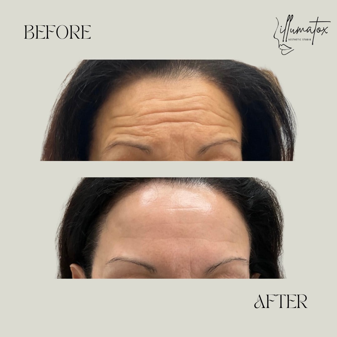 A before and after showing softened forehead lines after wrinkle relaxer treatment at Illumatox