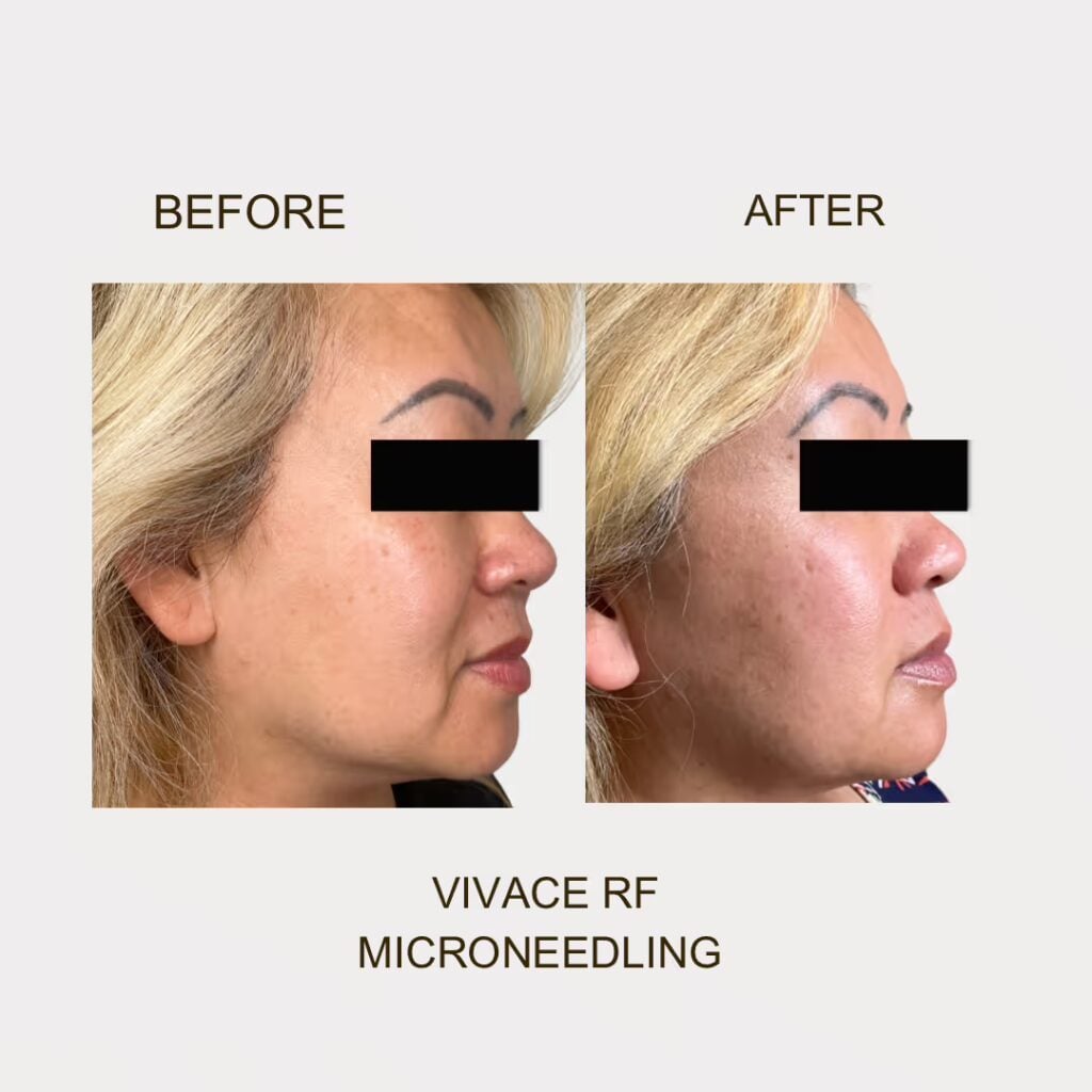 Before and after Vivace RF microneedling on the cheek and jawline at Illumatox in Neenah
