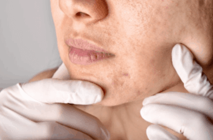 Say Goodbye to Acne Scars